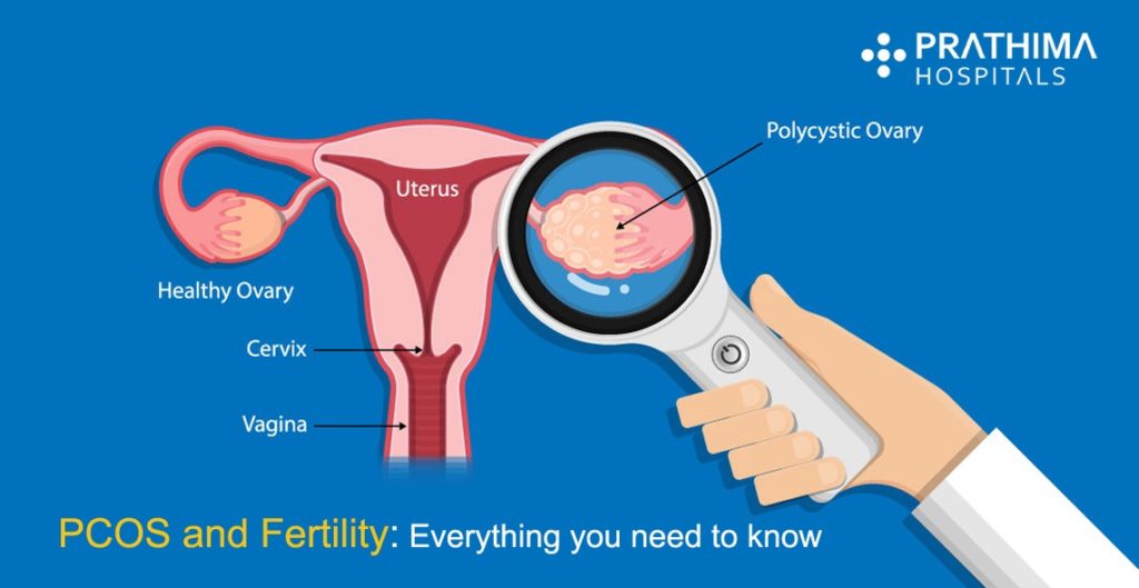 PCOS infertility