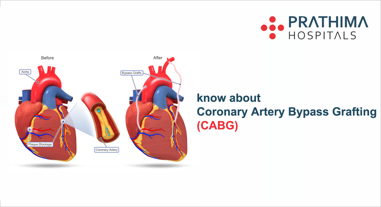 coronary artery bypass grafting