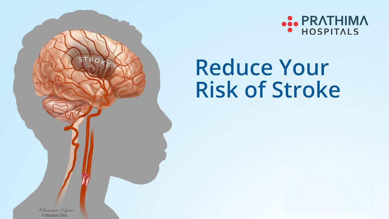 S with stroke. Фаст инсульт. Stroke Symptoms. Avoid stroke.