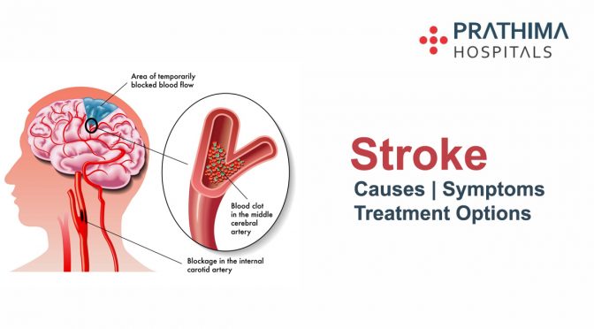 stroke causes symptoms and treatment options