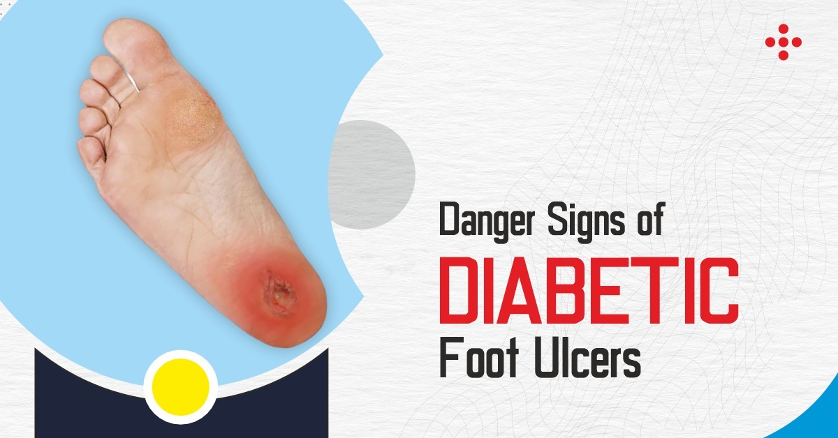 Diabetic Foot Ulcer Treatment