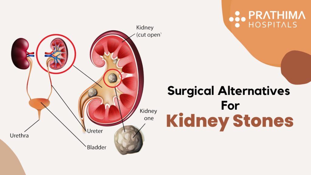 treatment for kidney stones by best Urologist in Hyderabad