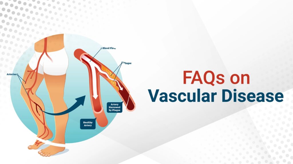 Vascular Diseases